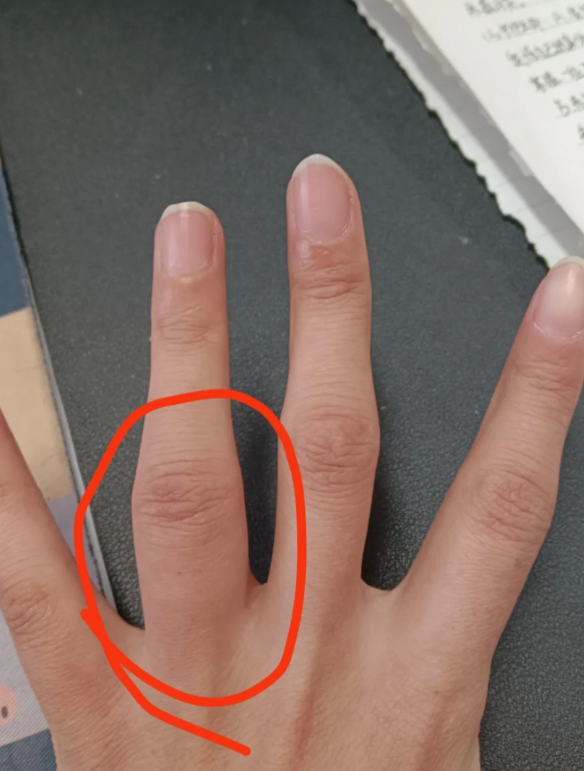 远端指间关节肿痛常见原因包括局部外伤,手指关节炎和痛风,需要篙据