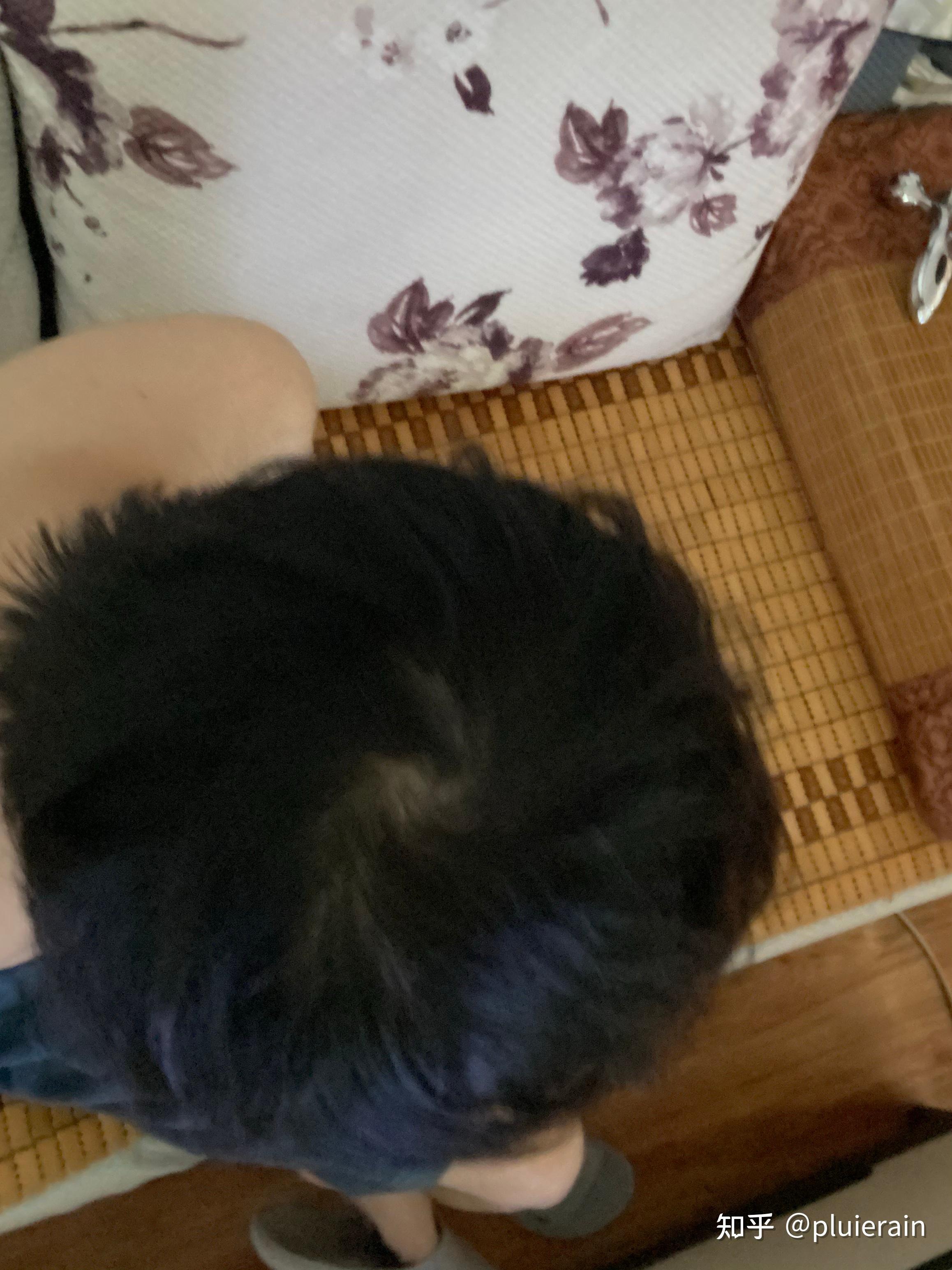 大三的一个男生21岁头顶漩涡处头发少得可怜以前头发很茂密晚上基本12
