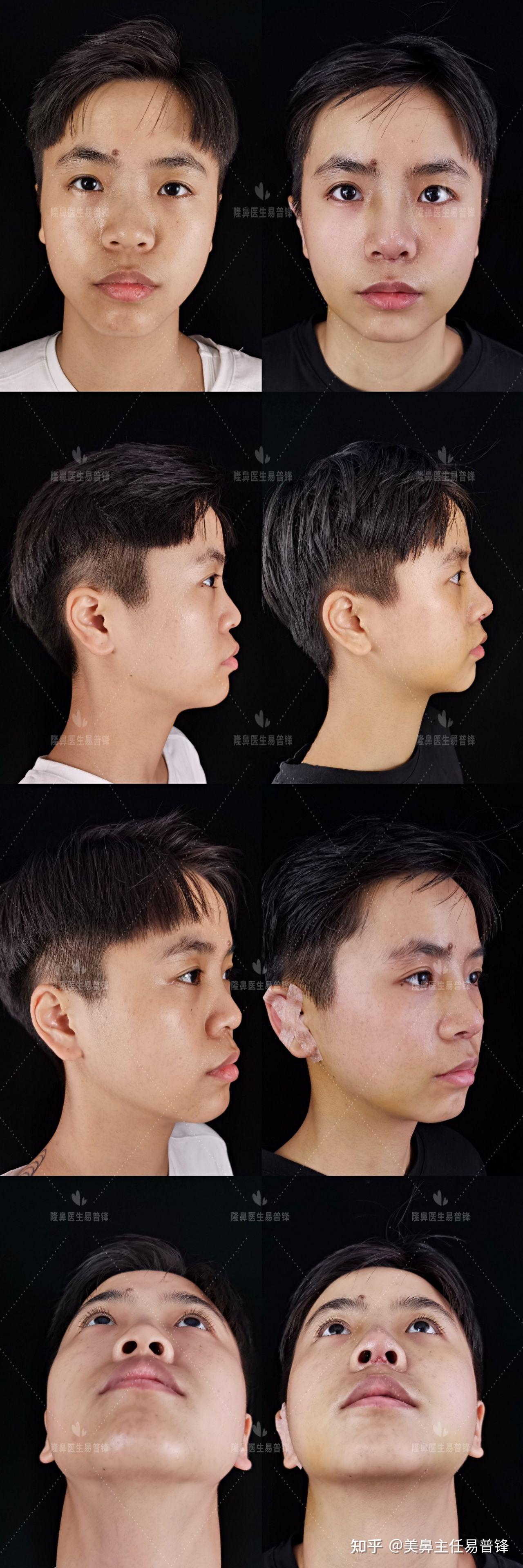 局麻耳软骨隆鼻姑娘术后第7天效果图反馈