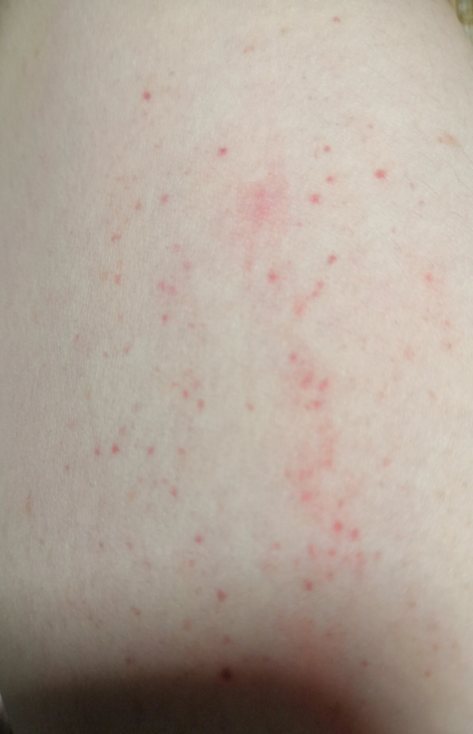 胳膊内侧的小红点