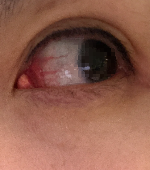 内眼角长肉疙瘩可能是正常的泪阜,也可能是病理性的翼状胬肉