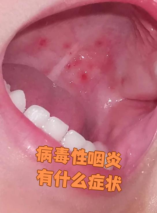 病毒性咽炎是由病毒引起的咽黏膜,黏膜下组织