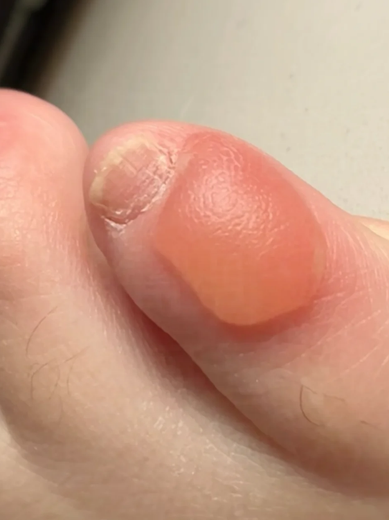 脚磨起泡了想好得快,关键要做好三件事:休息,冷敷和用药