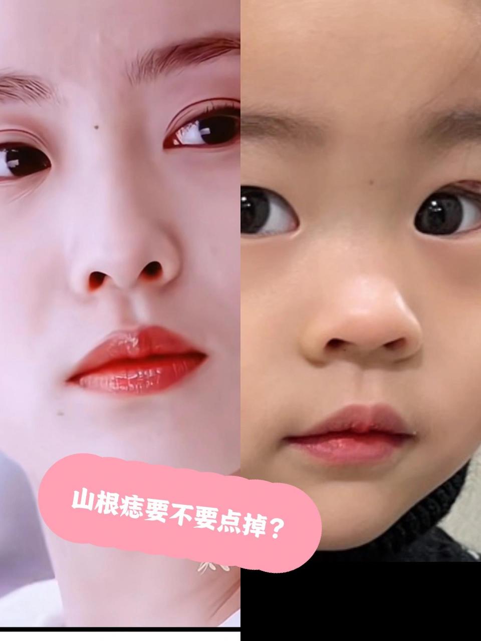 山根痣(水厄) 关于我闺女这颗痣我查了好多资料.