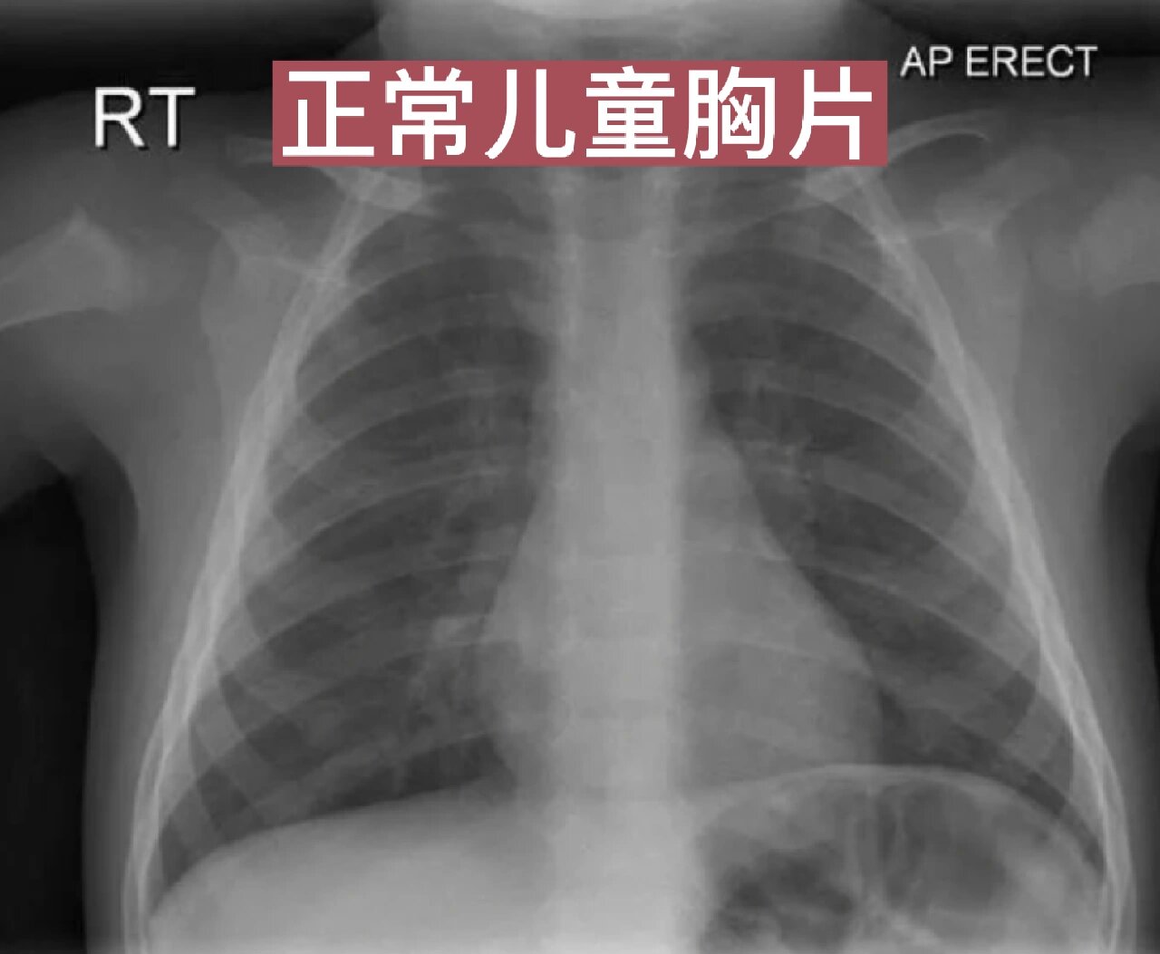 各种肺炎x线胸片图解图片