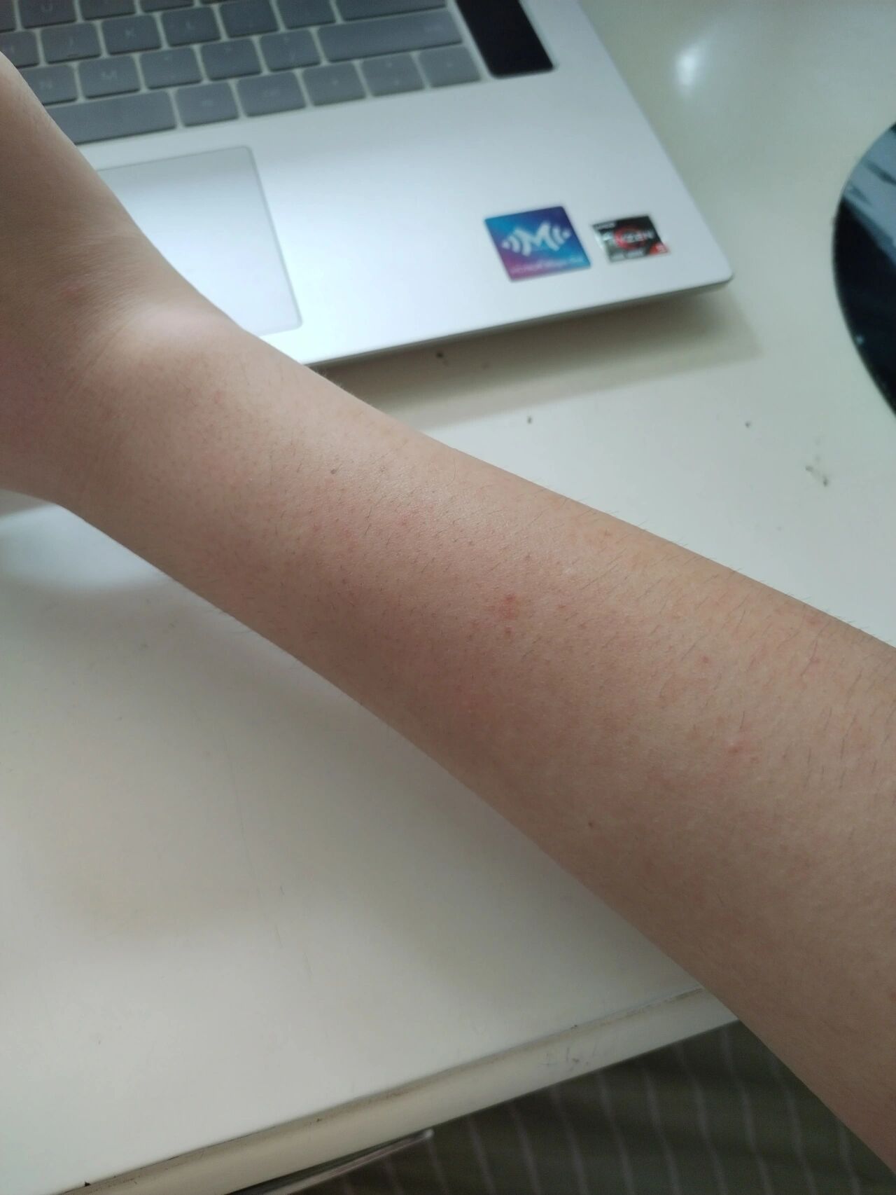 紫外线过强了吗只要出去一会回来就会起红点点,胳膊上手背上密密麻麻