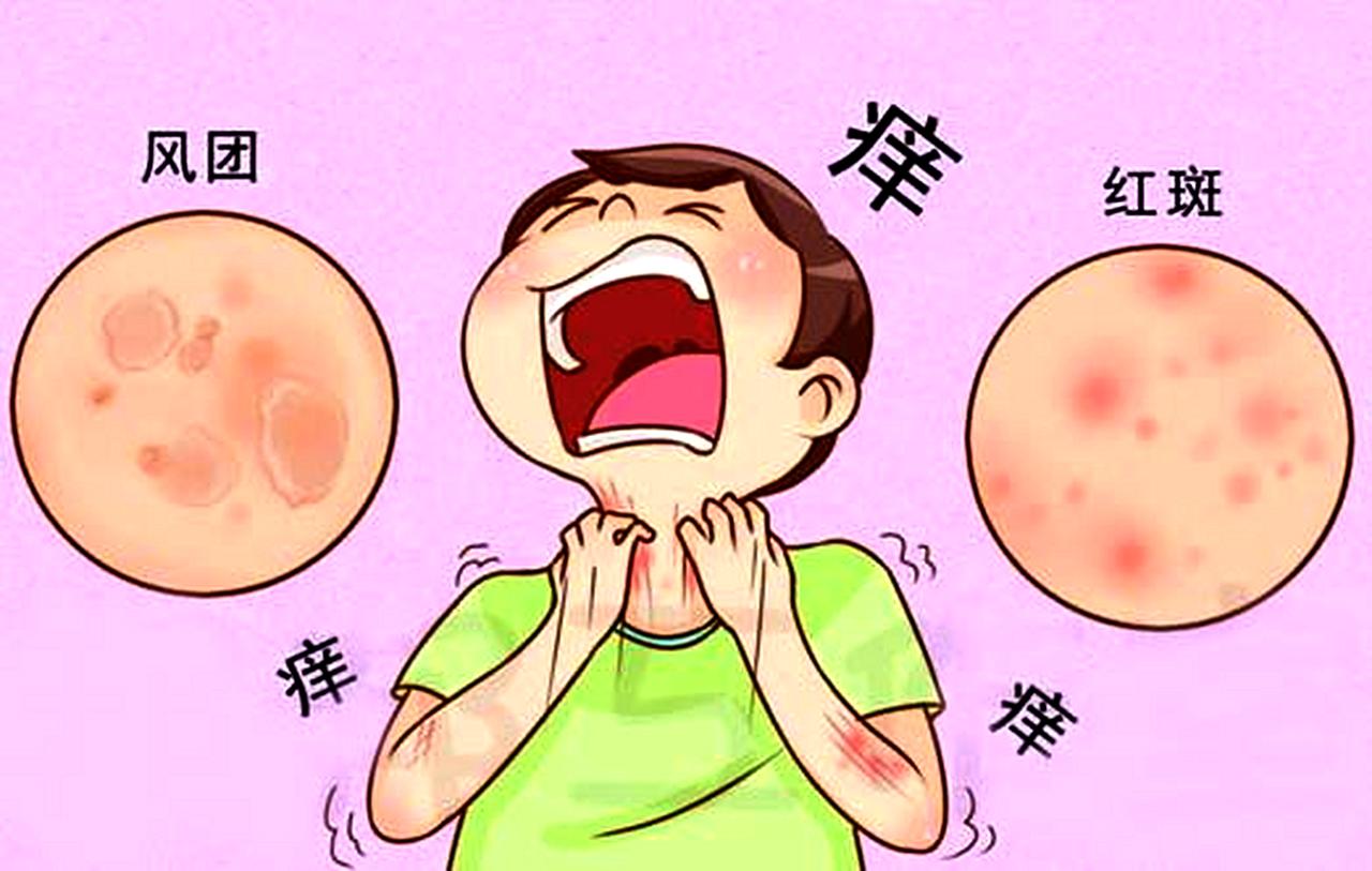 广州皮肤病#  家里有老人孩子的要特别注意,像这种荨麻疹反复发作的