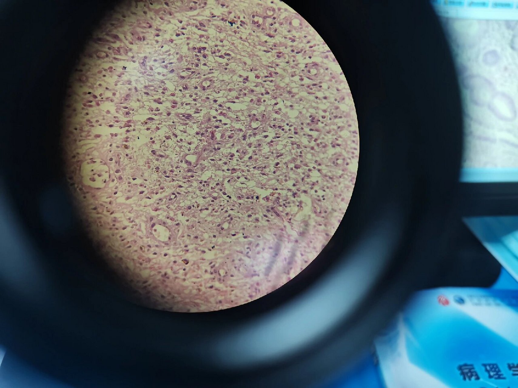 病理切片-肉芽组织 病理描述:肉芽组织(granulation tissue)是指由