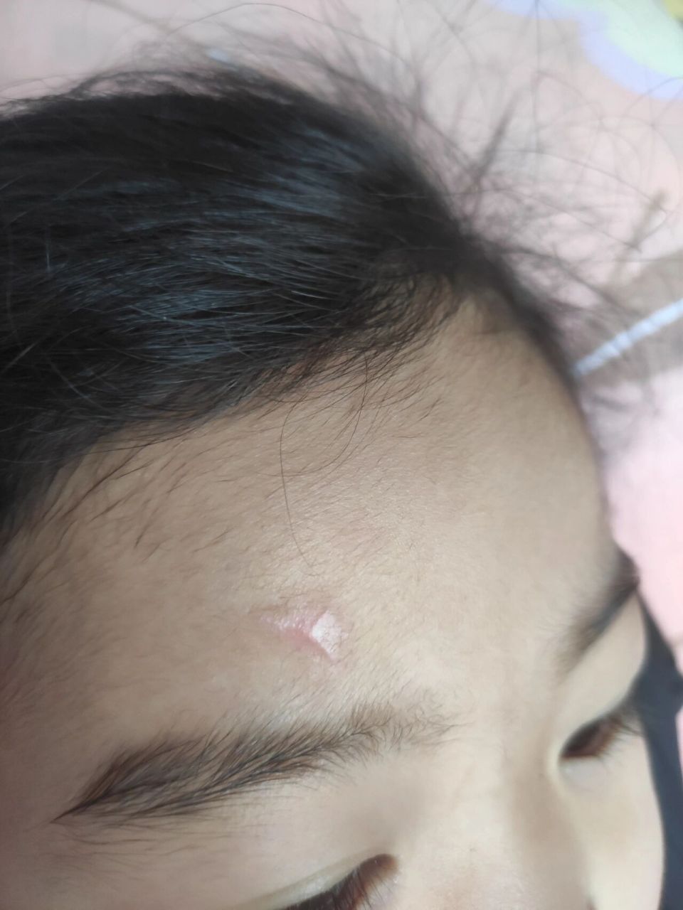 缝针伤疤多久才不发红