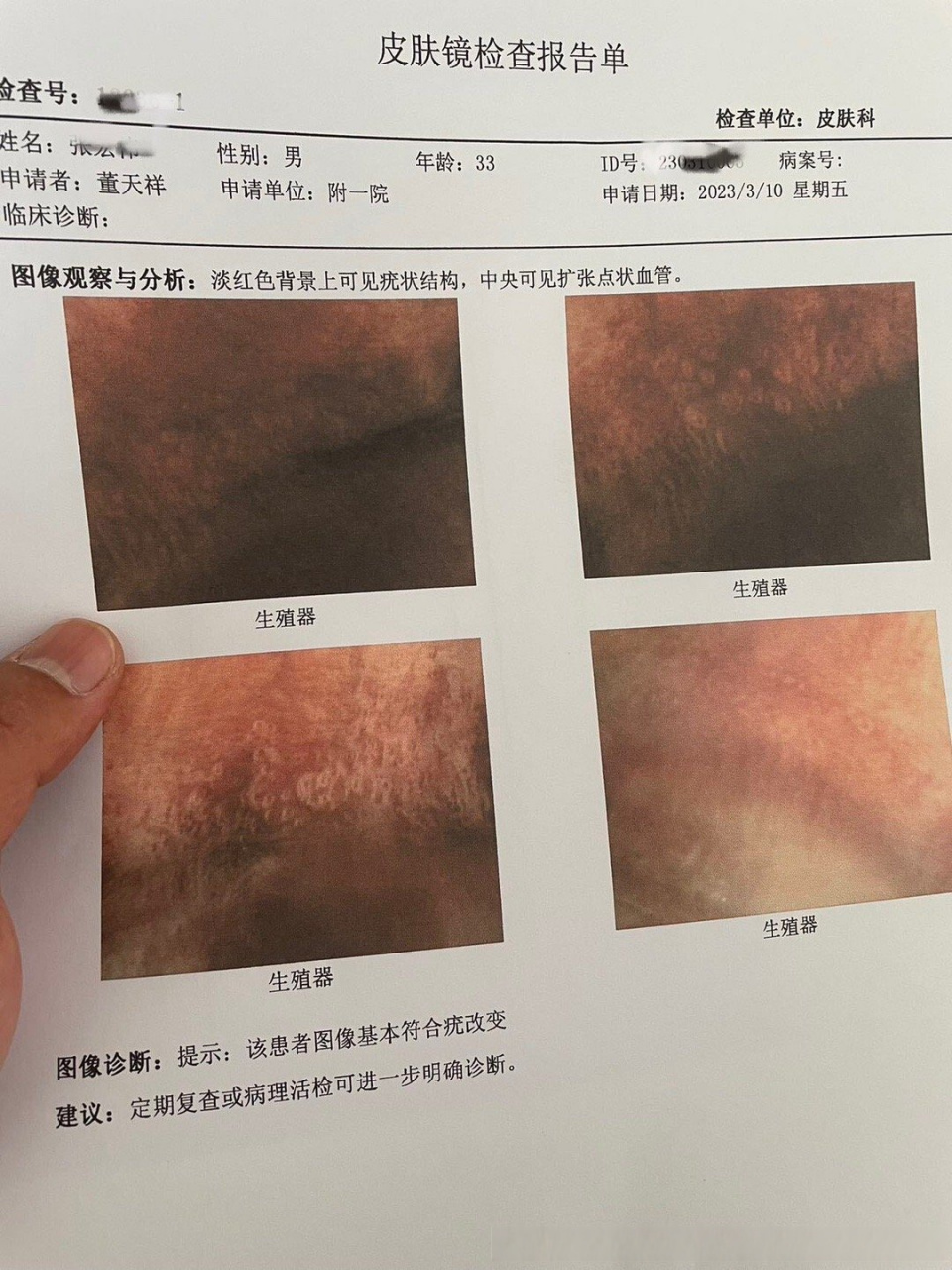 健康美好生活计划# 龟头边缘有疣状结构;已光动力治疗完;等创口愈合去
