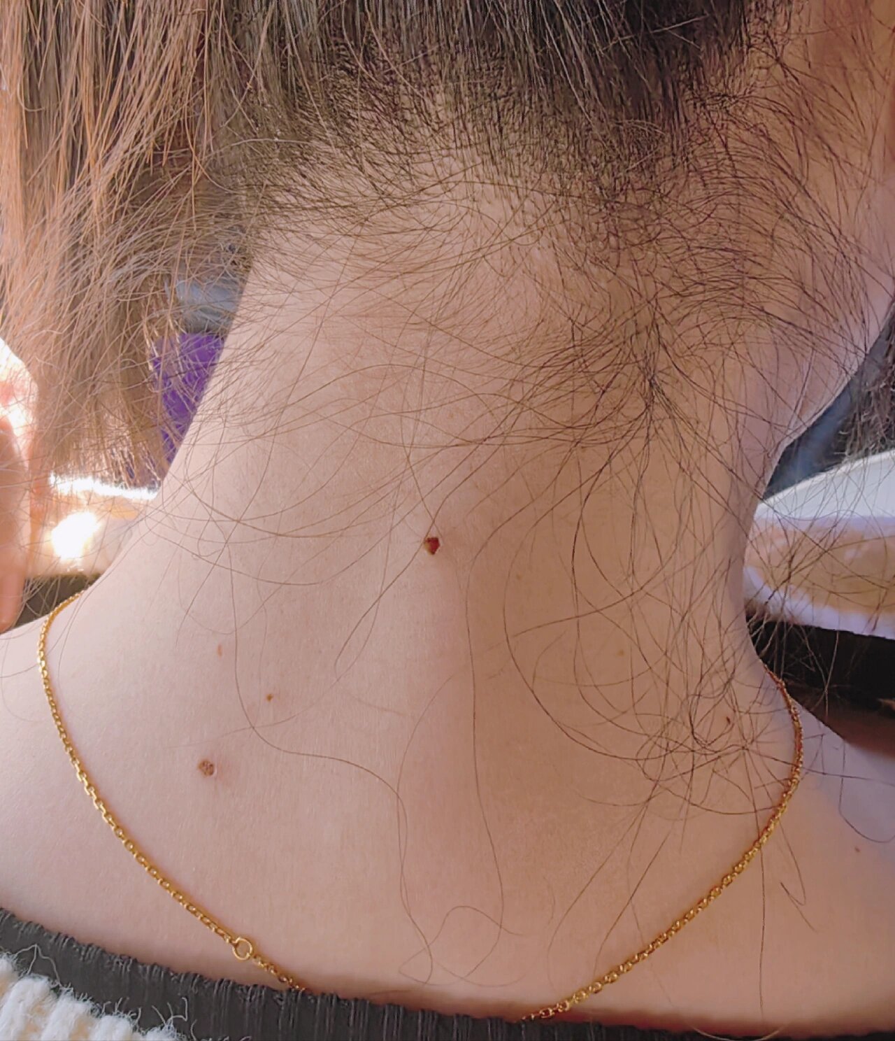 脖子后边凸出的肉痣!