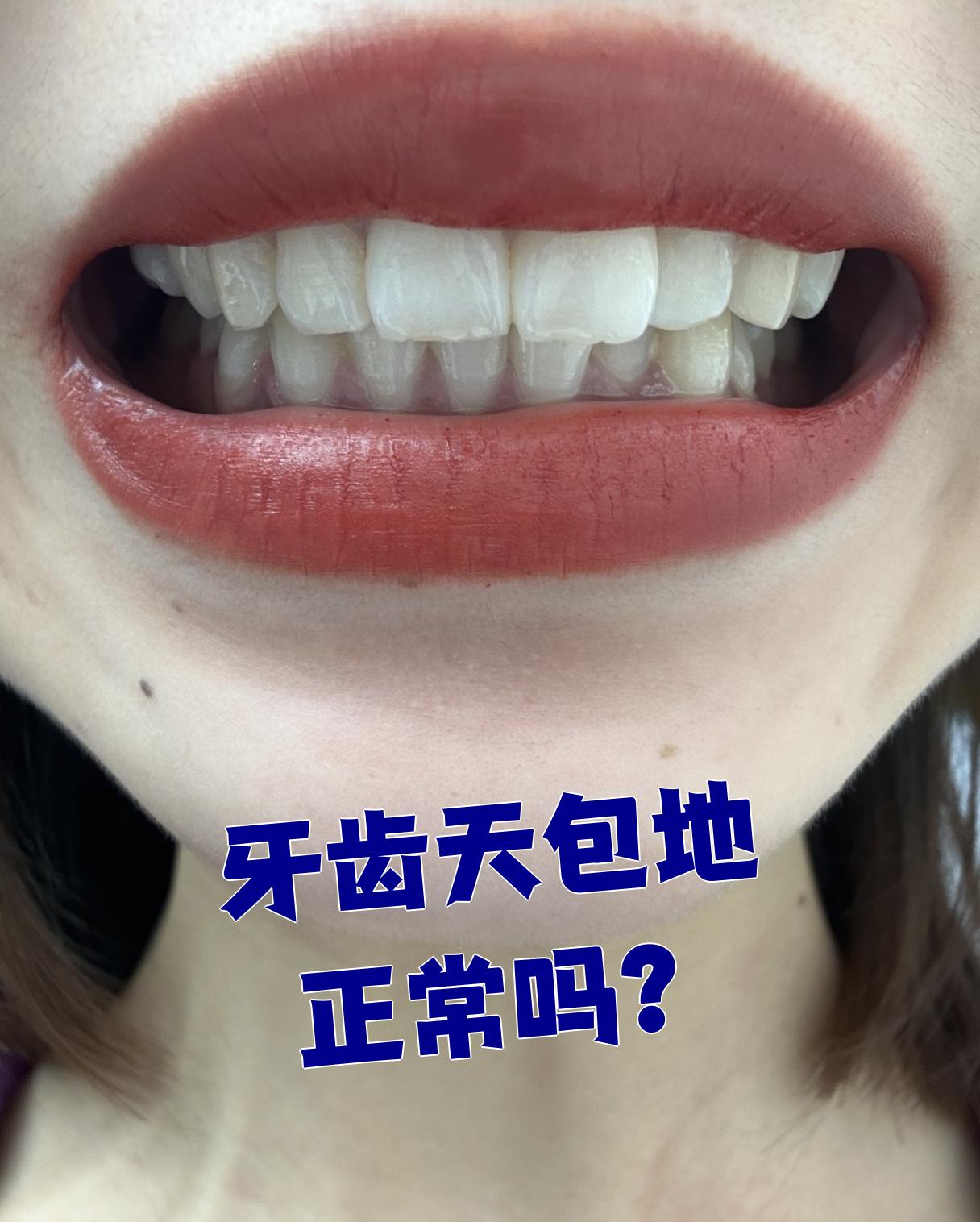 牙齿天包地正常吗?