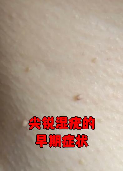 尖锐湿疣的早期症状