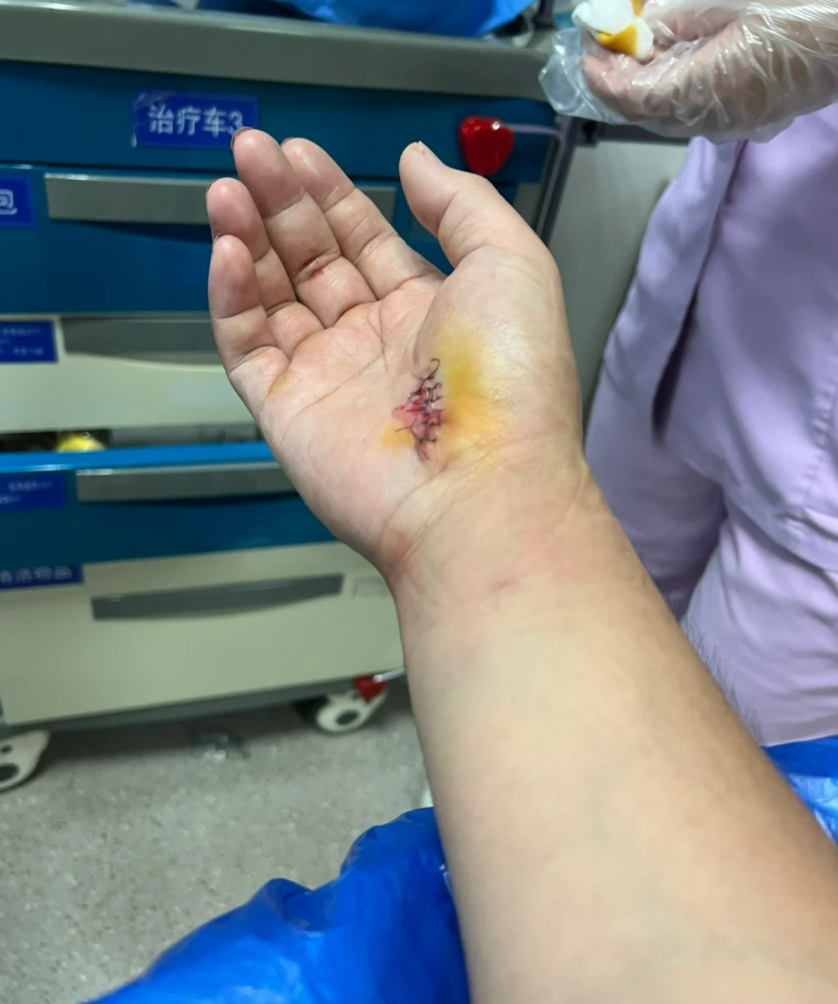 要是深浅屈肌腱都断了,所有指间关节手受伤照片打球手指受伤打篮球