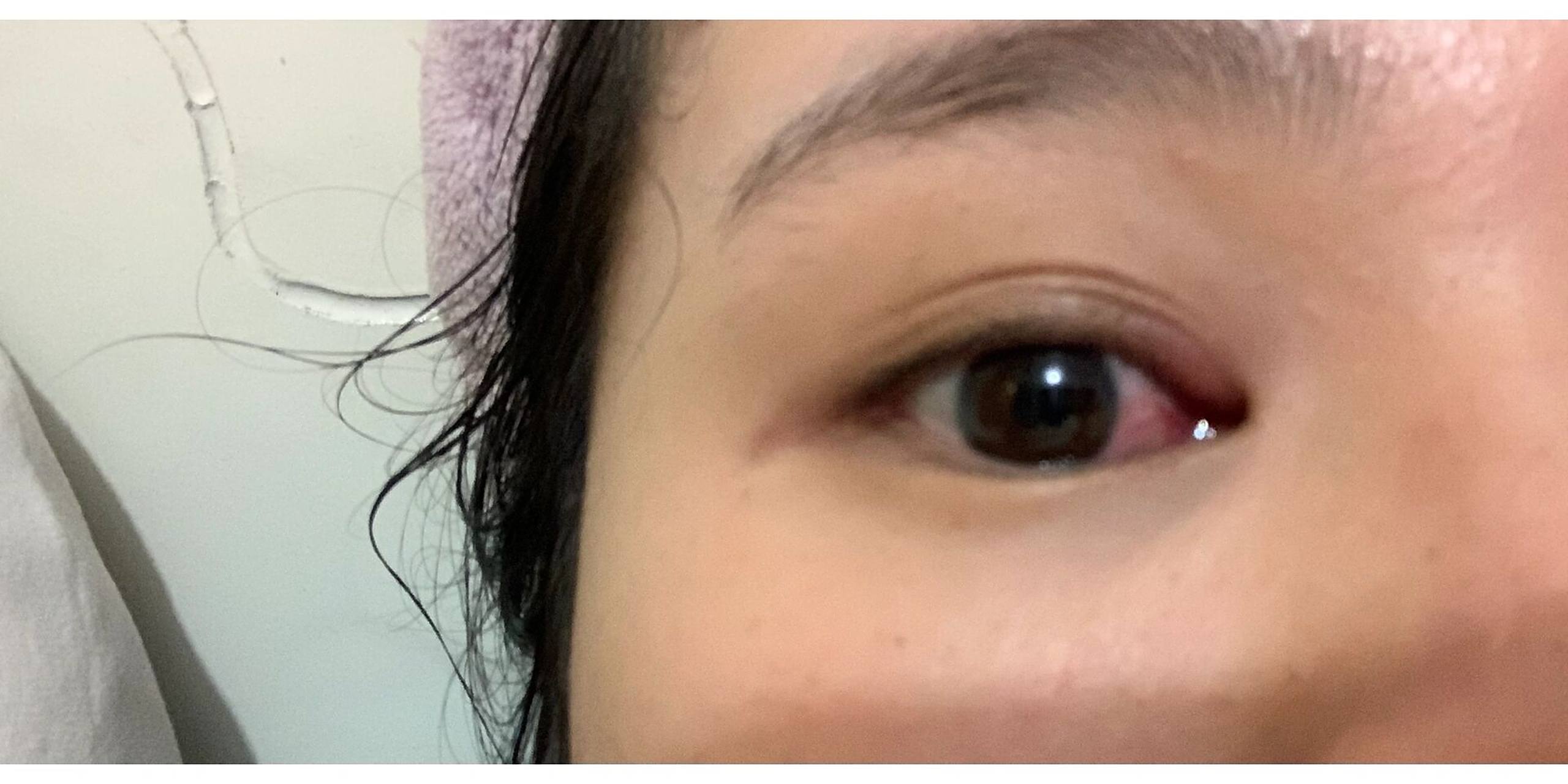 内眼角红痒 四天了 用了药店买的眼药水一点用都没有 还老贵了40  刚