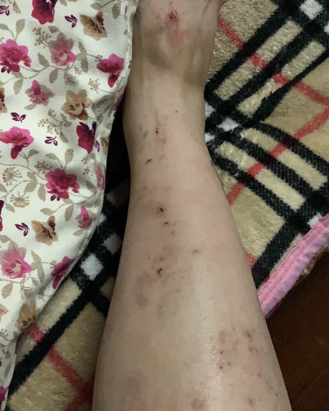 小腿总是痒到抓破皮,这种情况最常见的原因是湿疹和神经性皮炎