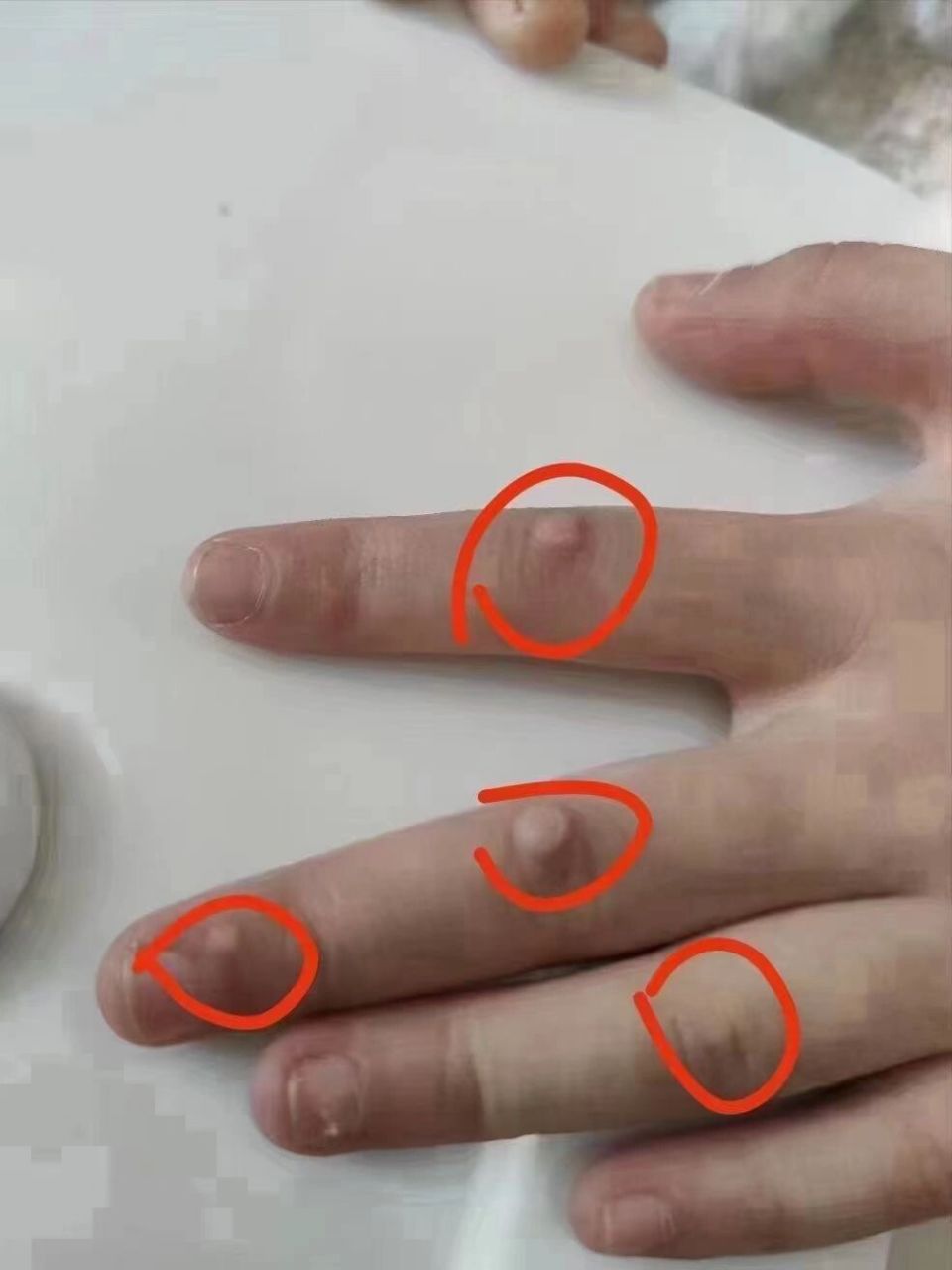 还会自体传染, 越来越多,67 全手传染了一个的时候赶紧治