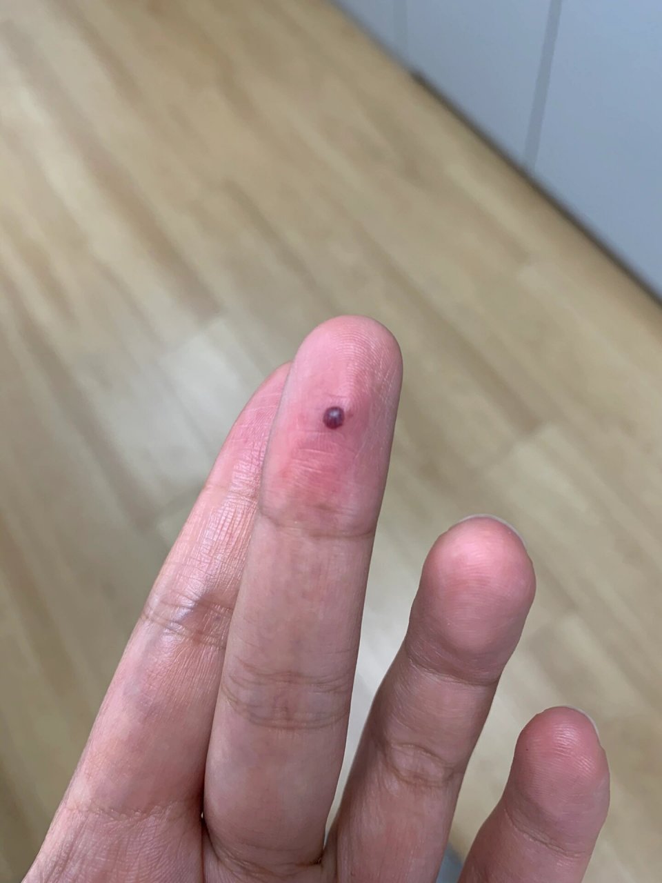 手上突然起了一个血包是什么 早上才发现的,这是什么呀,需不需要去