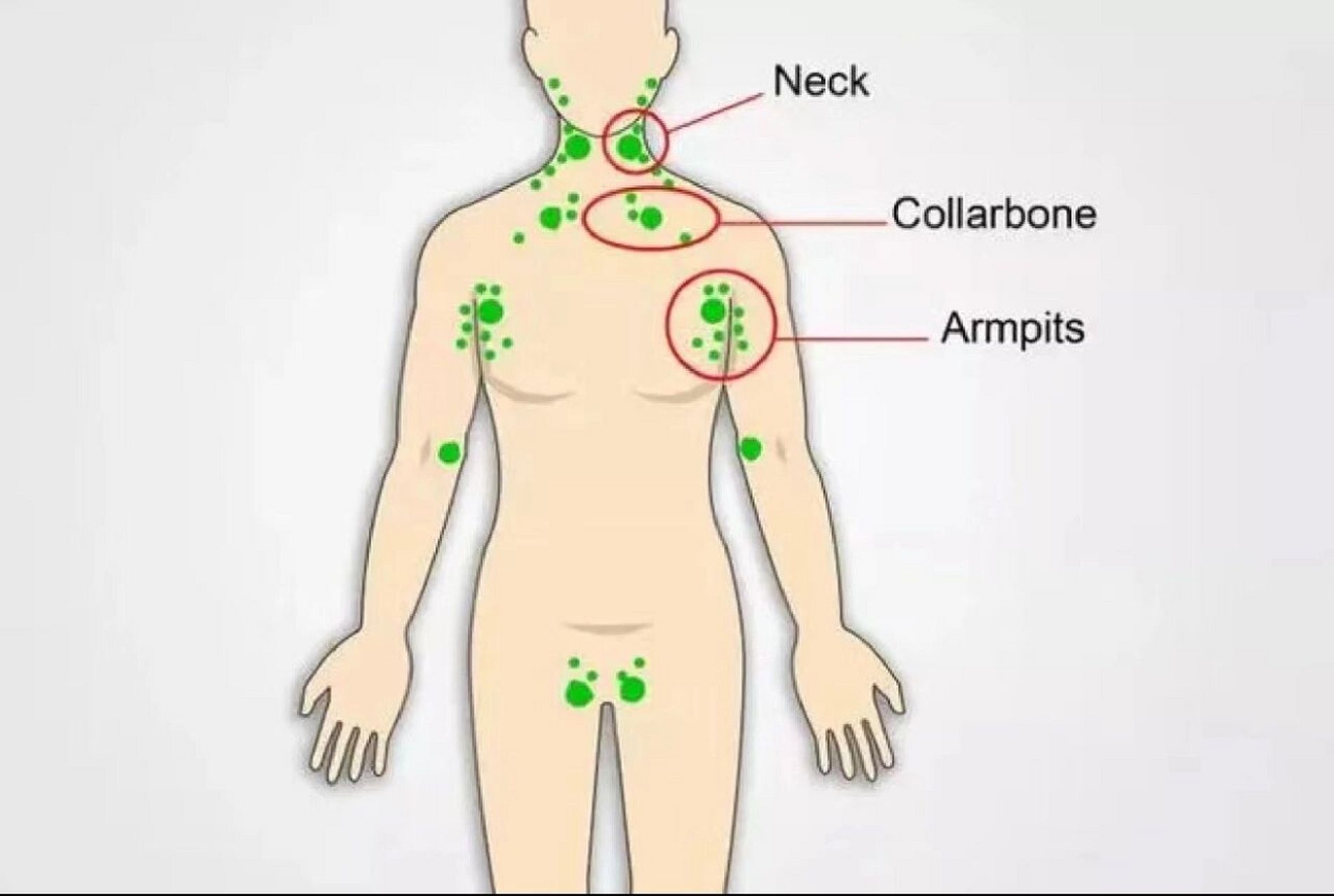 这是乳腺癌,淋巴癌的警号!乳房的毒素没有