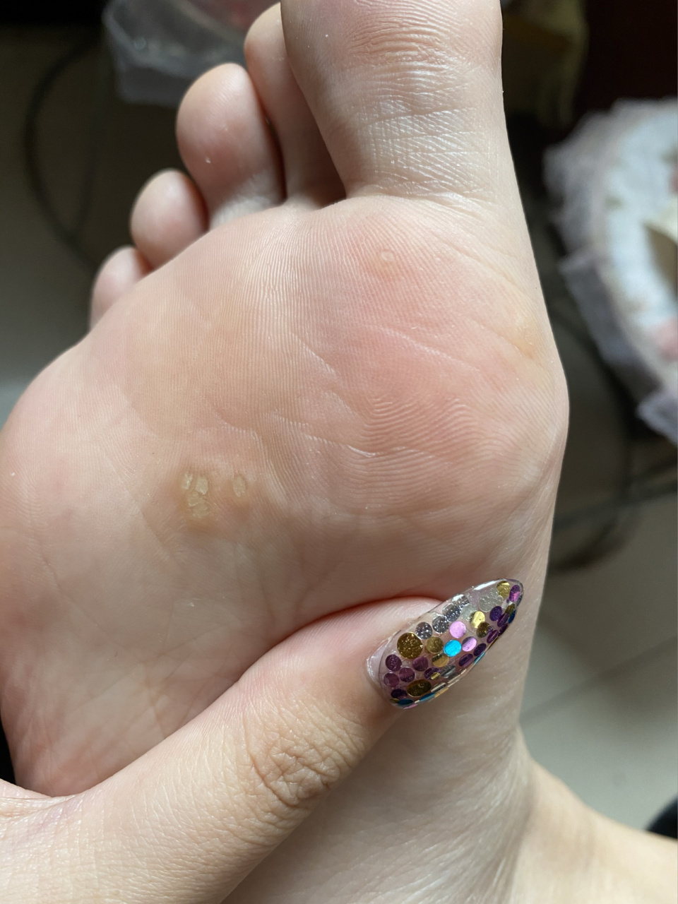 大家帮我看看这是鸡眼还是跖疣