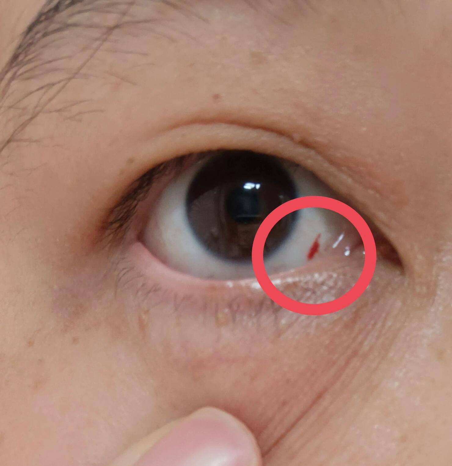 眼睛白血球有红血块,是否需要看医生