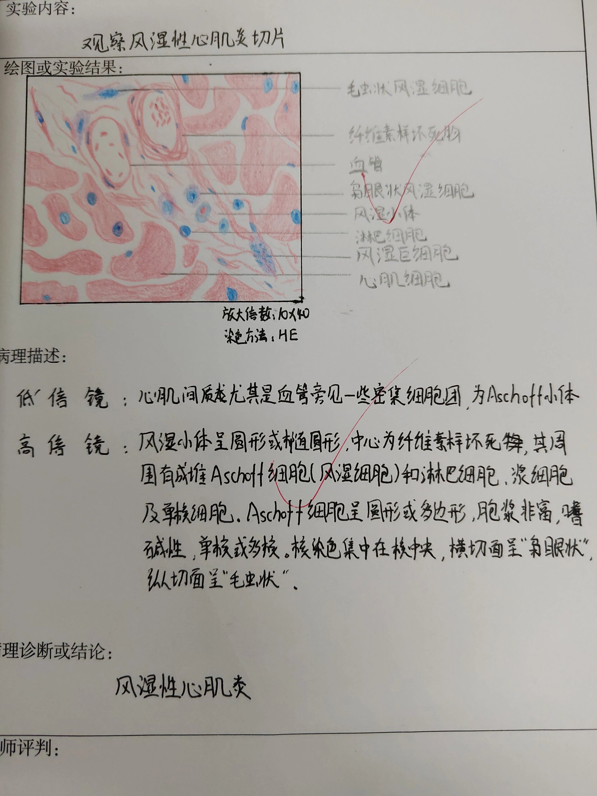 风湿性心肌炎病理图片