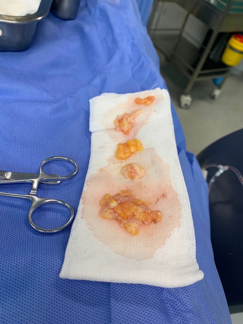 乳腺纤维瘤旋切手术分享一点都不痛 我这个乳腺纤维瘤有点大而且血流