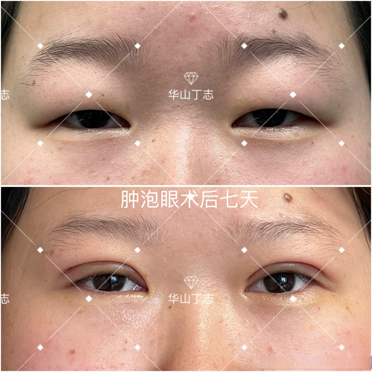 案例展示:超级肿泡眼,全切术后七天拆线,还会进一步消肿,变化大不大?