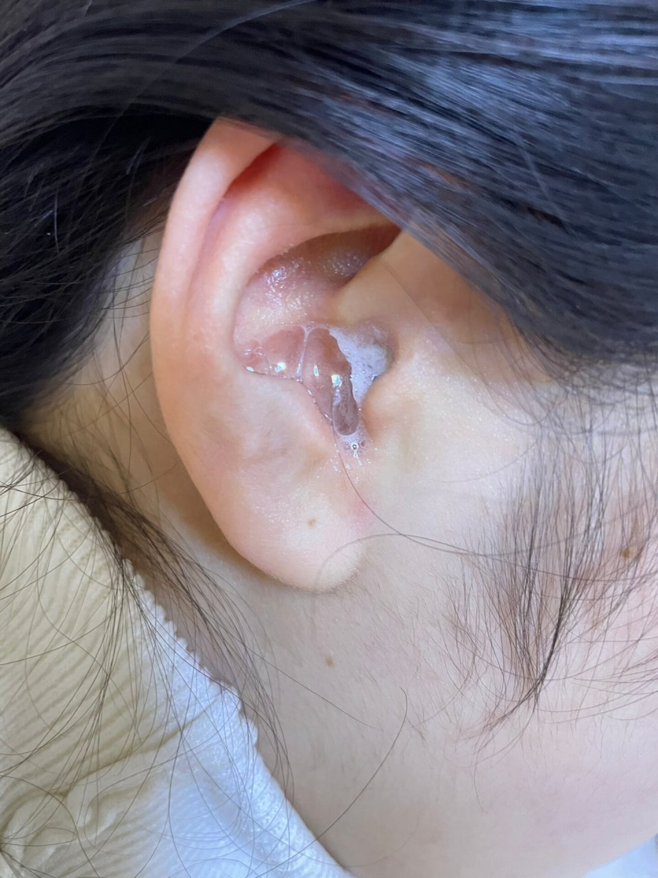 太痛了 耳膜穿孔快半年了 想着去医院检查下约手术时间 之前耳朵受伤