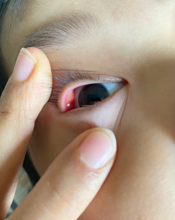 如果是睑腺炎,你会觉得眼皮红肿热痛,摸起来有个硬疙瘩还特别疼