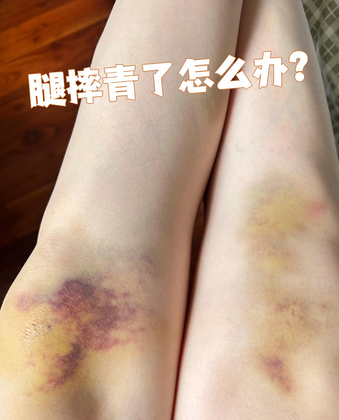 腿摔青了可以这样处理: 紫韧Ｖ够疃 ,然后冷敷受伤部位,把腿抬高,有