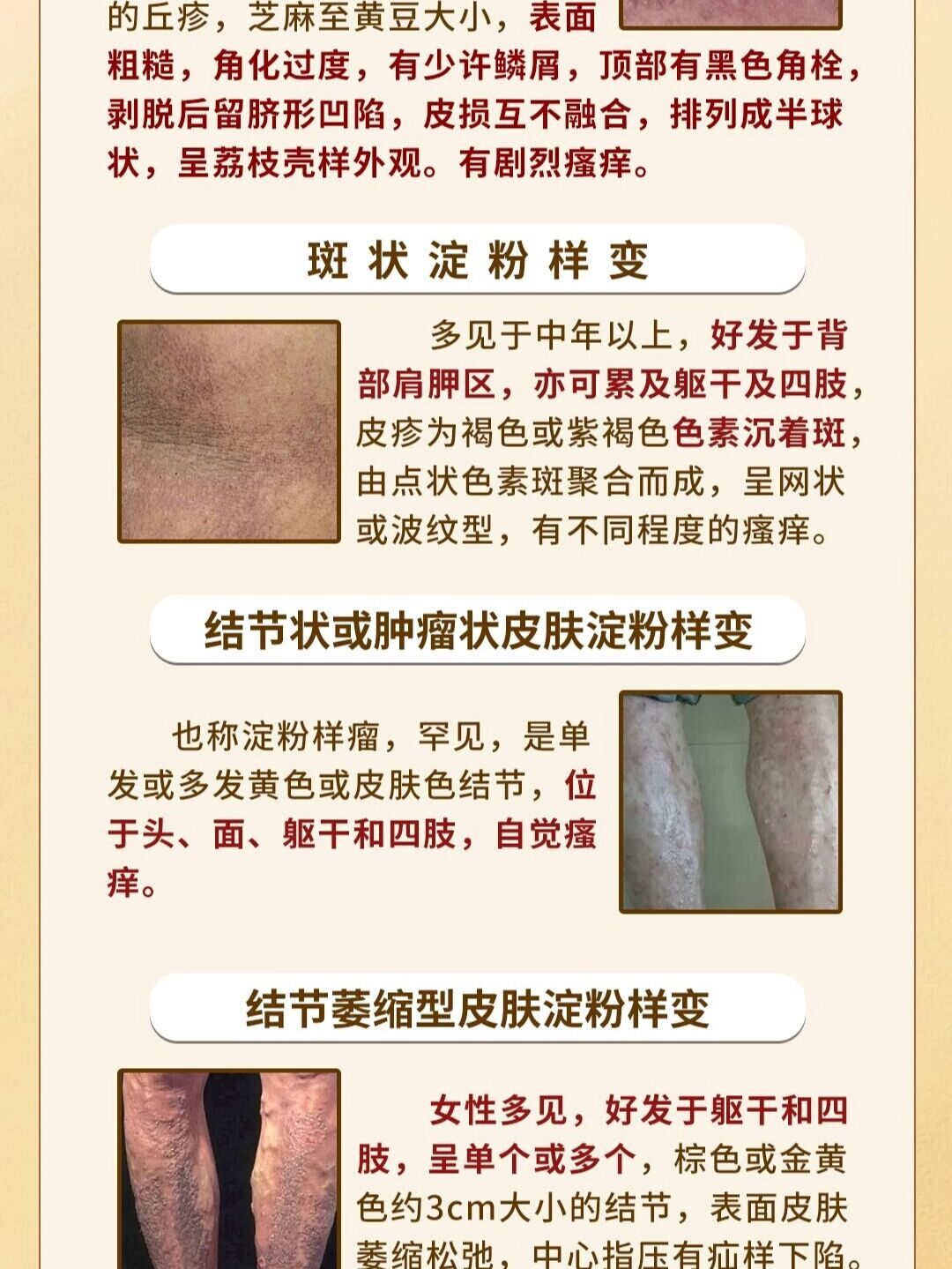 皮肤淀粉样变证型自辨 1, 苔藓样淀粉样变 又称淀粉样变苔藓,临床最
