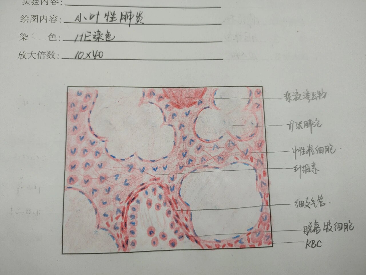 小叶性肺炎绘图图片