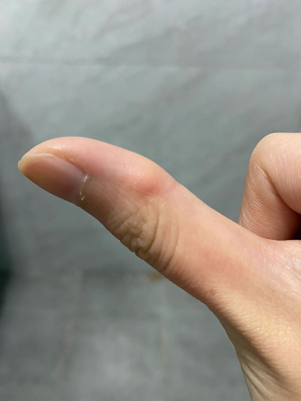 大拇指关节突出,有些疼 不知道怎么回事,感觉大拇指关节变的突出,还有