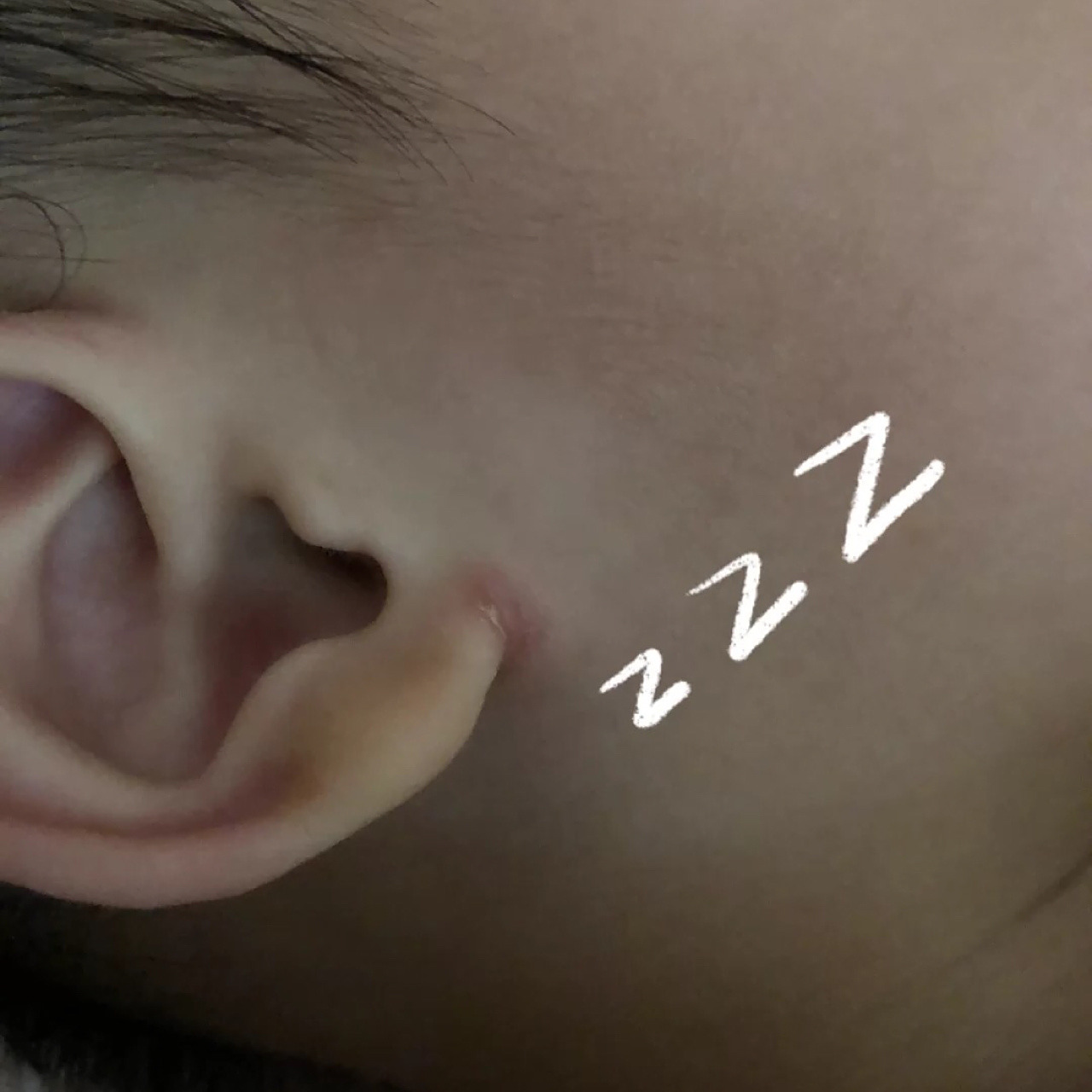 宝宝耳朵裂开 耳垂裂开 一直以为是宝宝喜欢抓耳朵才导致耳垂下方裂开