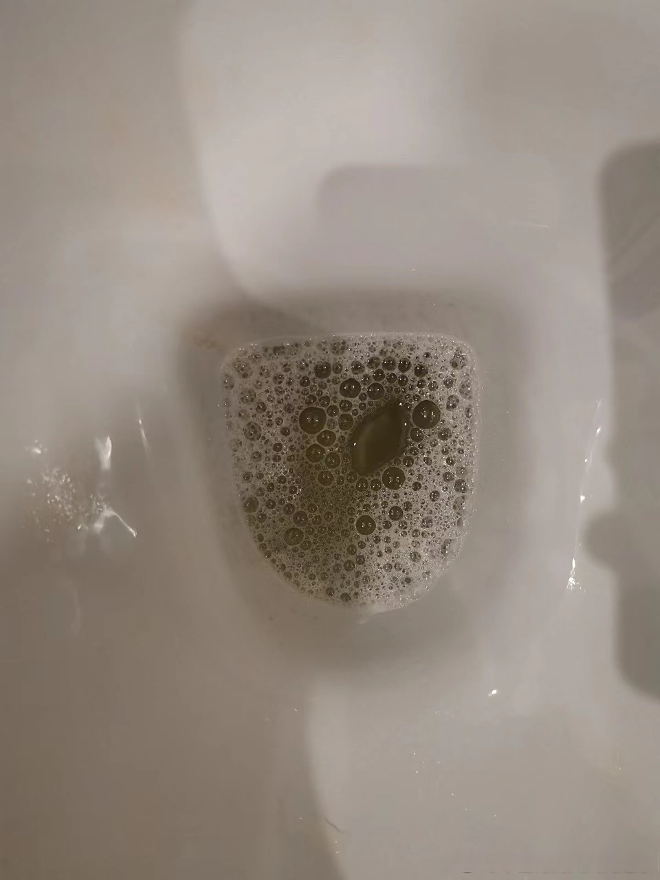 发现尿液里有许多细小且经久不散的泡沫,做完尿常规检查发现尿蛋白 号