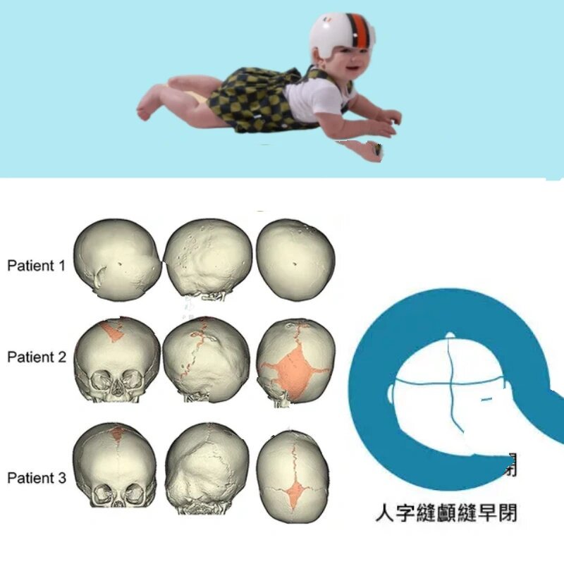 人字缝颅缝早闭 一侧人字缝早闭引起斜头偏头 要与体位性偏头有区别