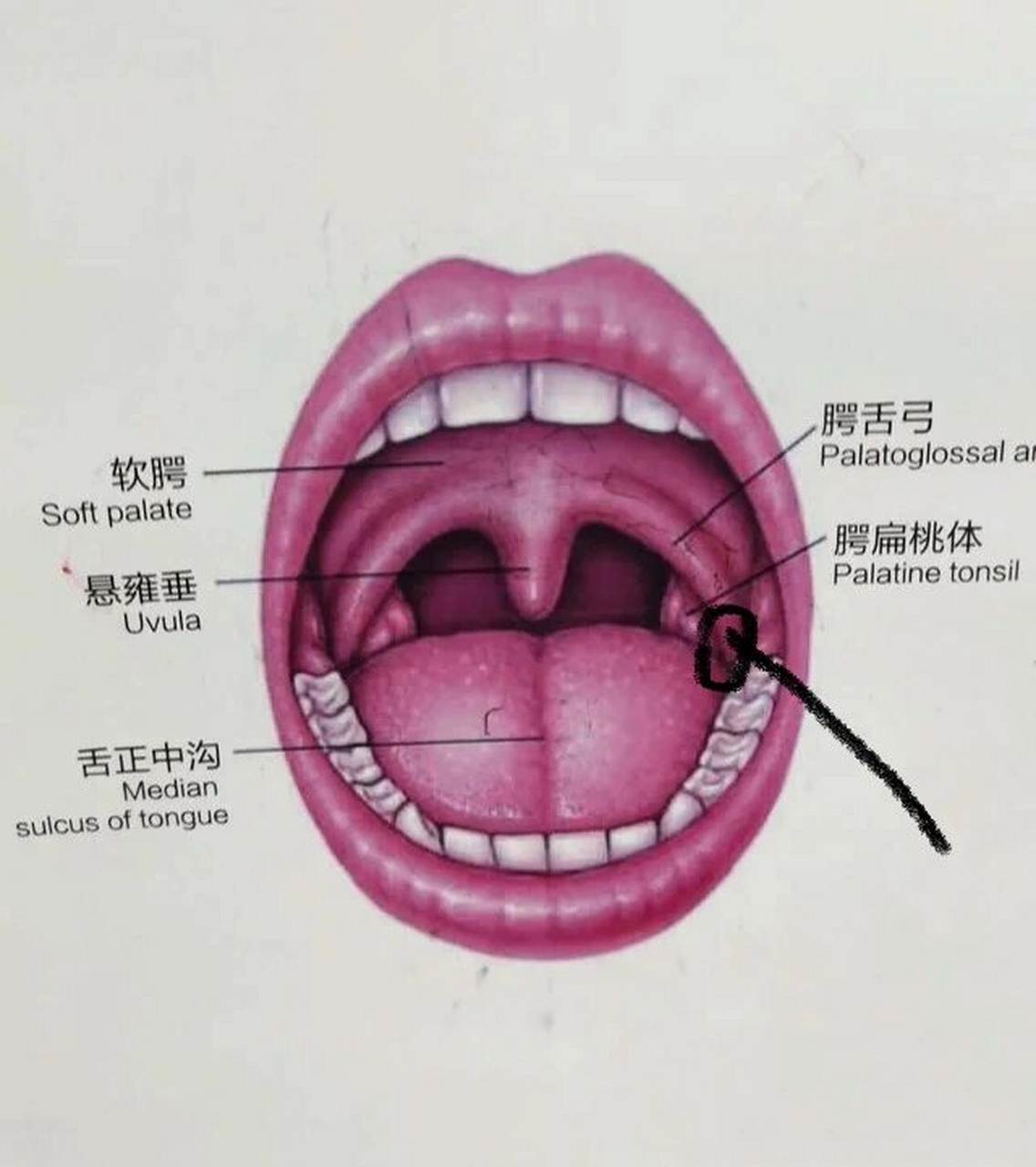 嗓子疼 家人们 扁桃体旁边 舌头根部长了点肉芽一样的东西 就是说好痛