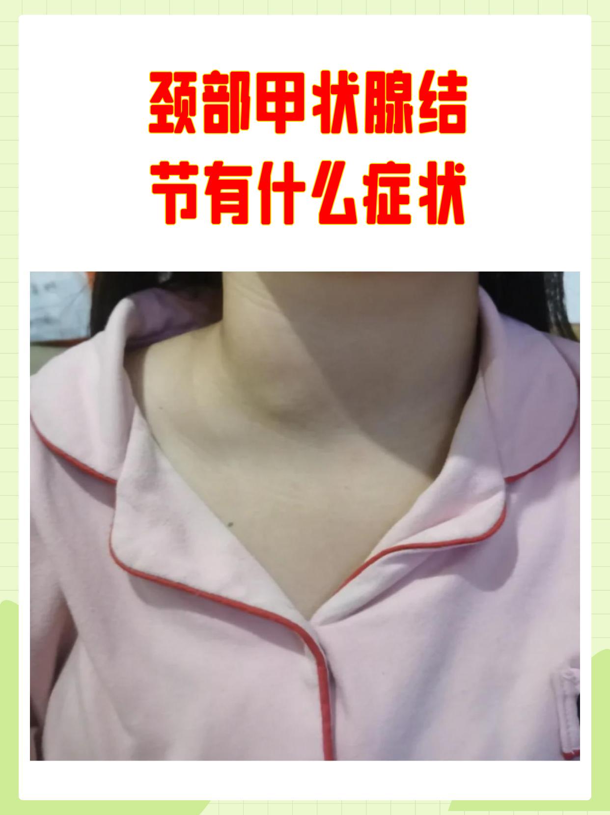 如果结节较大或功能异常可能出现颈部肿块吞咽不适声音嘶哑或甲亢