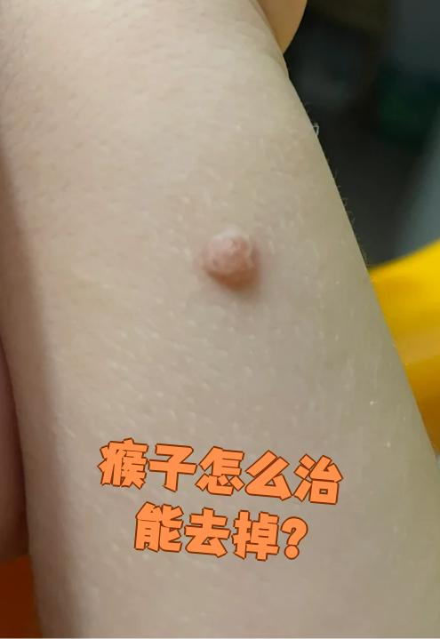 人身上为什么会长瘊子