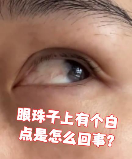 如果是眼白部分的白色斑点,则可能是泡性角膜炎或睑裂斑