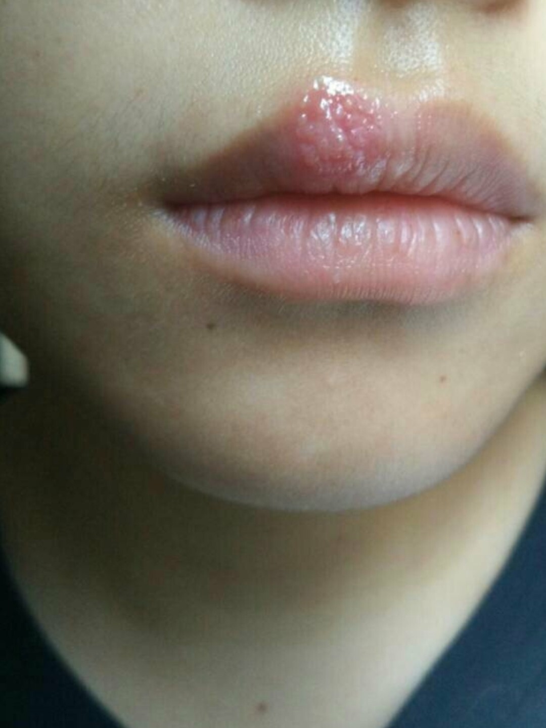 嘴上长这种小水泡是上火了吗