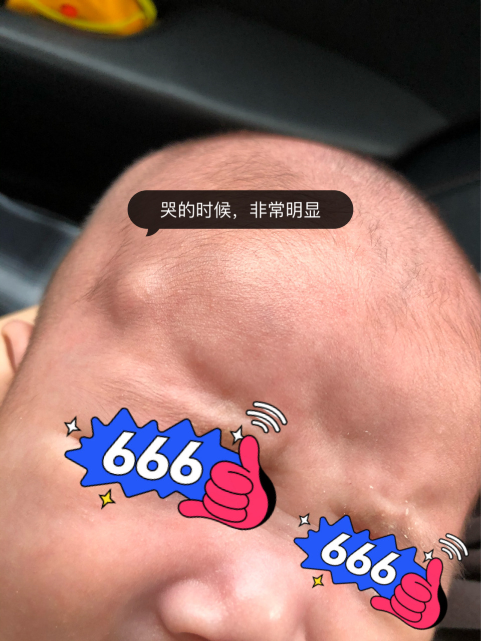 新生儿皮下囊肿 我们家宝宝大概在出生5-6天的时候发现,刚开始不知道