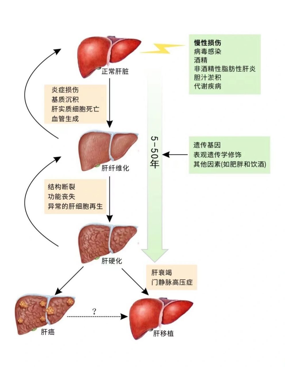 肝硬化机制图图片