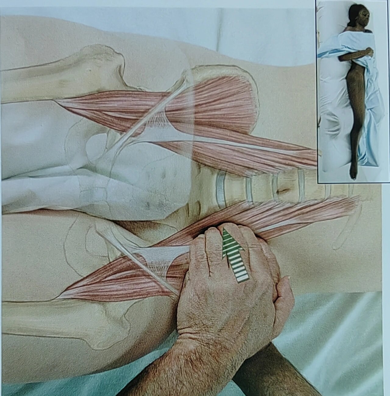 腰大肌松解手法