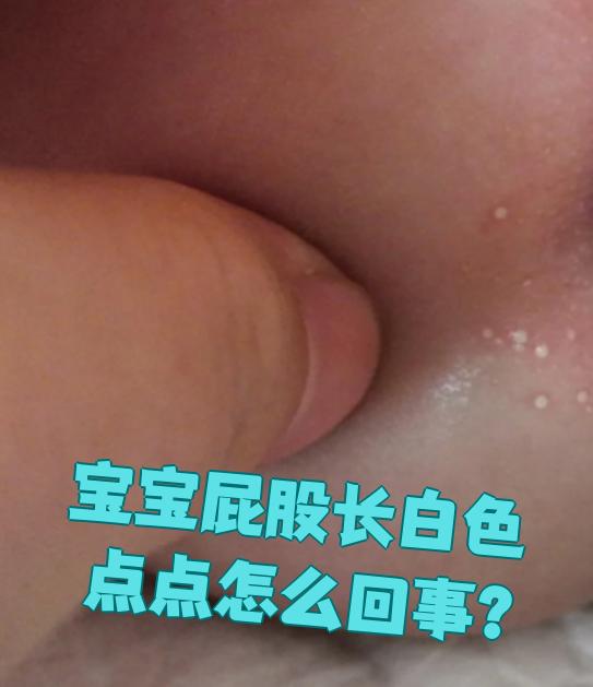 宝宝屁股出现白色点点,常见原因是肛周湿疹或真菌感染