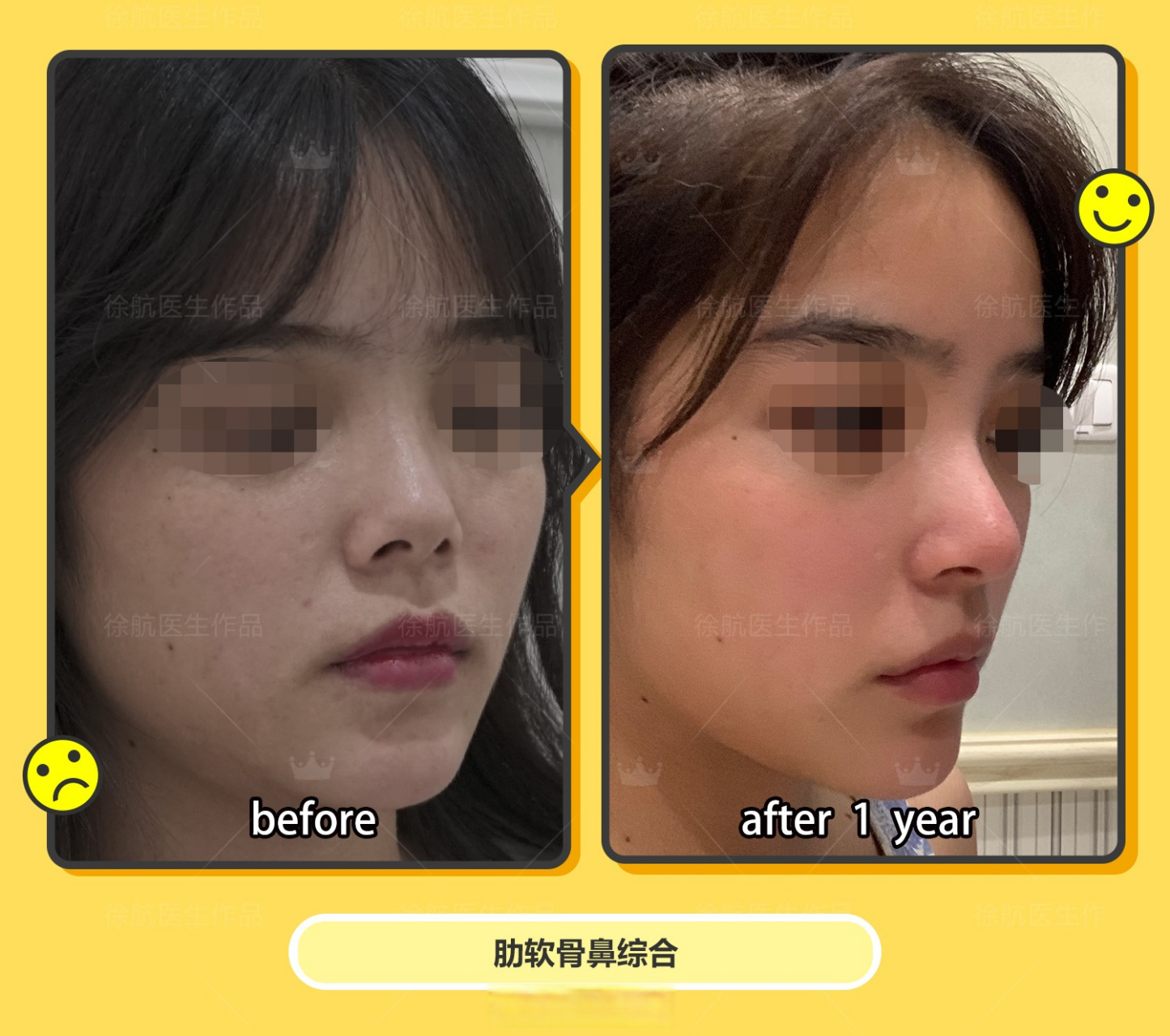但太短也不好看,幼态感的脸延长鼻子要掌握好度,避免过长显老.