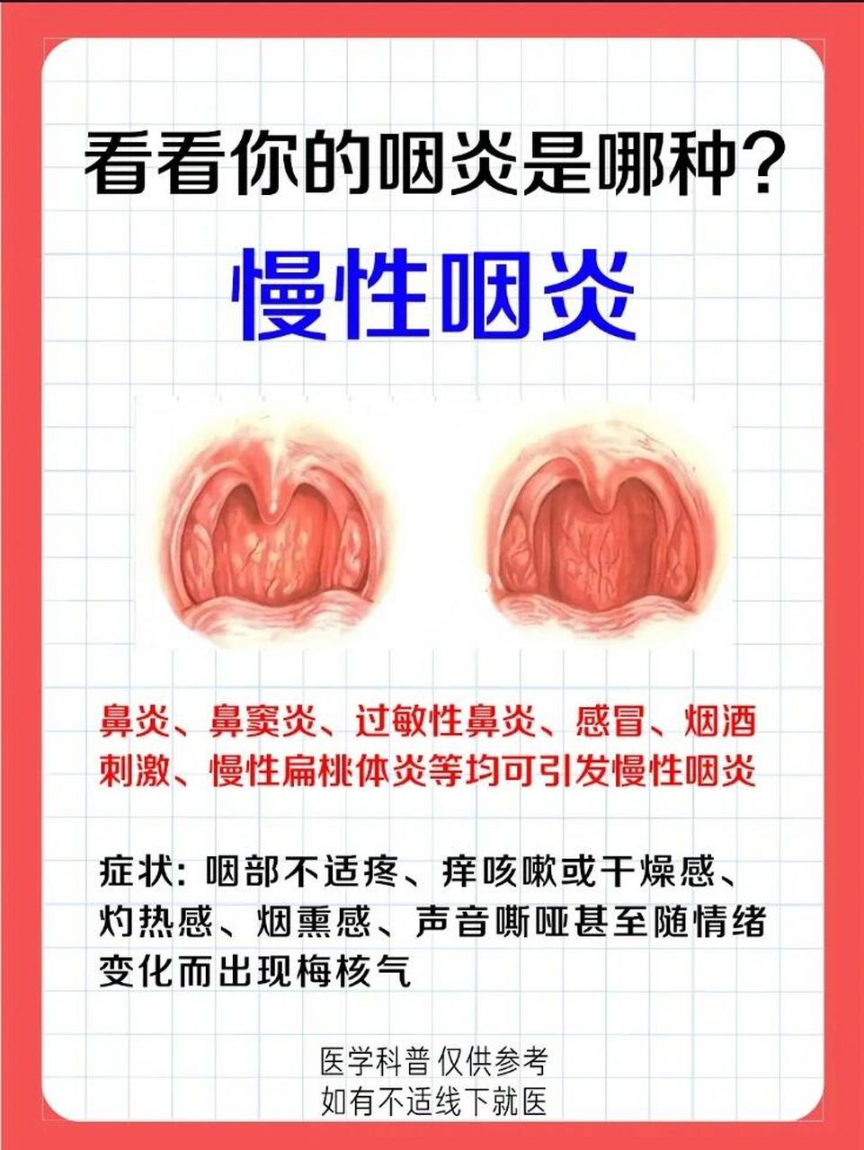 千万别把滤泡性咽炎当成慢性咽炎治 滤泡性咽炎的主要症状实际上是当