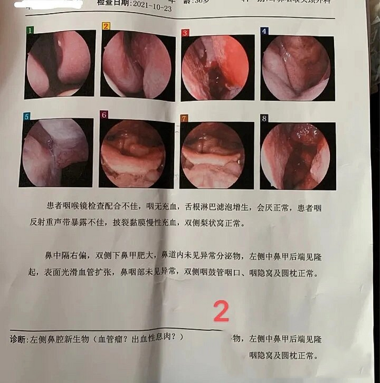 鼻咽癌国内确诊过程. 10月13日的检查也没有查到问题,诊断为咽喉炎.