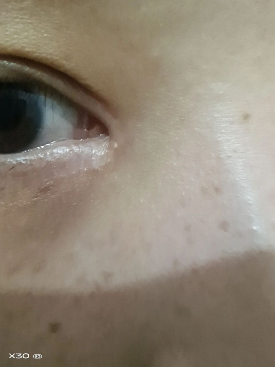 眼角有个白色的小疙瘩  是怎么回事啊.